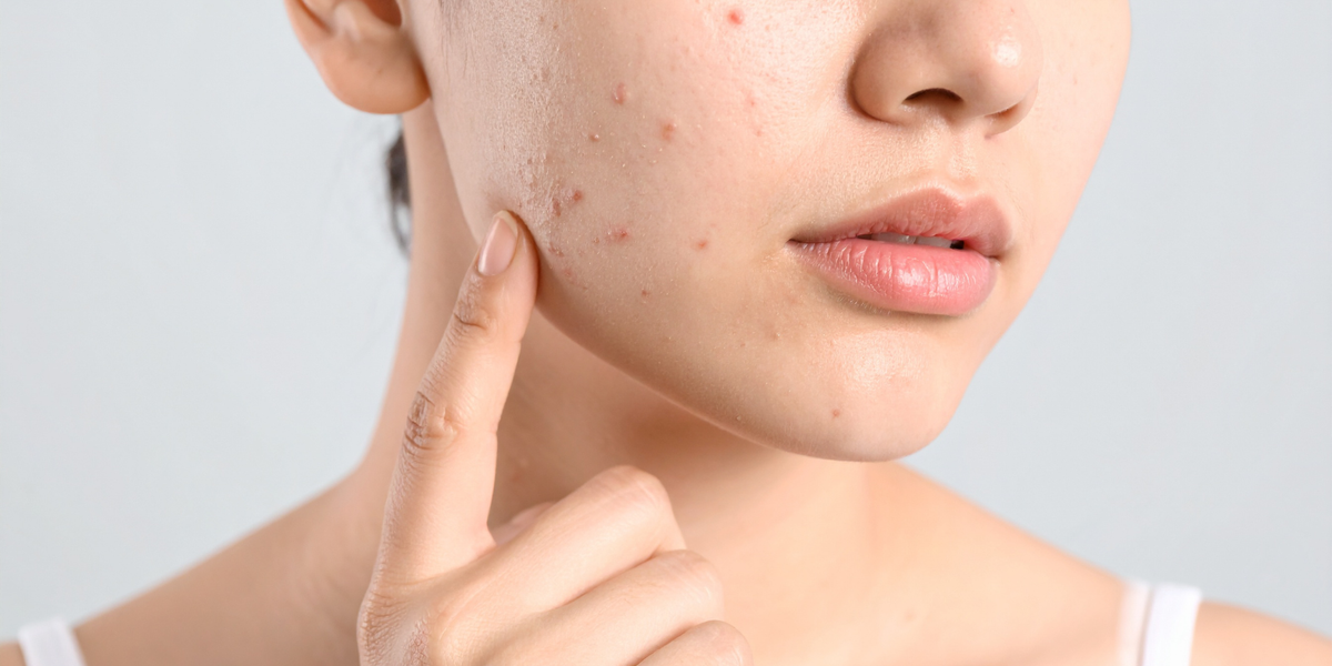 The Adult Acne Guide: Why Breakouts Don't Stop After Your Teens and How to Finally Clear Your Skin